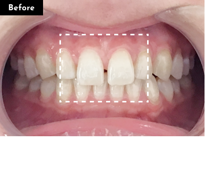 すきっ歯治療前 - Oh my teeth マウスピース矯正Basicプラン症例 Case 27